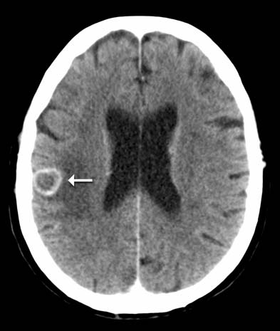 Imagen de CT del cerebro después de la administración de contraste intravenoso.