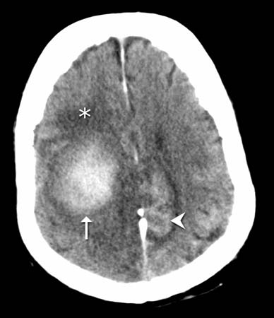 CT scan of a patient's brain showing an intraparenchymal hemorrhage.