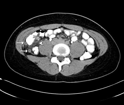 Abdominal CT scan showing appendicitis
