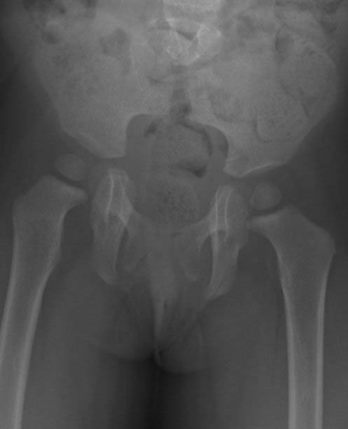 Rayos X de la pelvis de paciente pediátrico