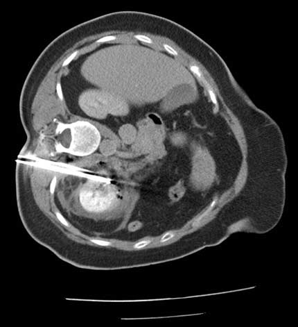 Radiofrequency ablation of a renal tumor: