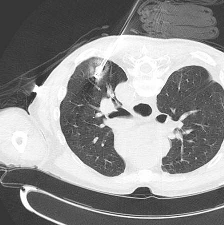  Imagen de electrodos de RFA colocados en el cáncer de pulmón de un paciente.