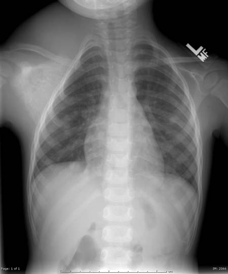 X-ray of a child indicating Ewing's Sarcoma.