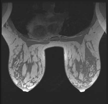 Imagen de RMN de ambos senos 