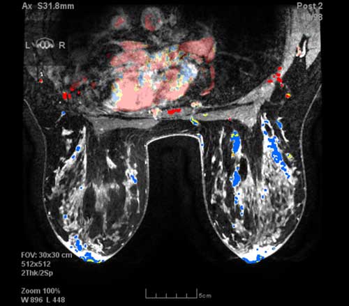 Breast MRI image