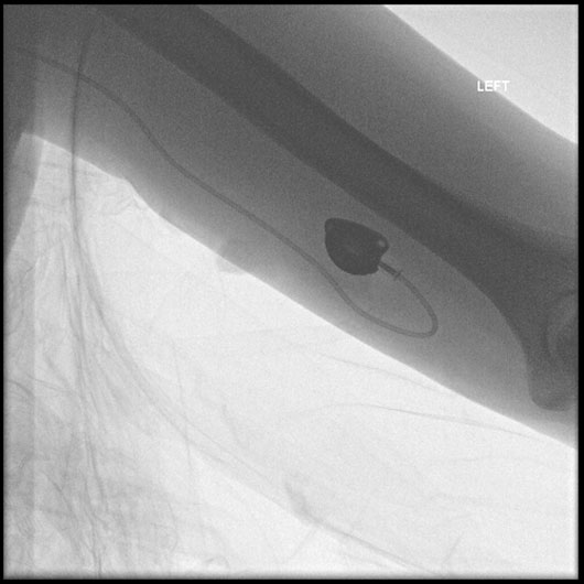 Image of a power port placed in the upper arm.