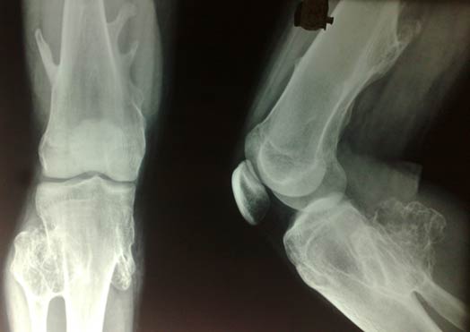 Bone x-ray