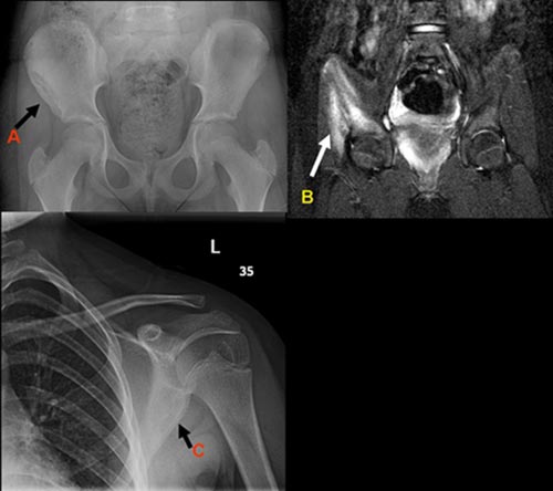 A series of images showing a lytic lesion in the right iliac (hip) bone