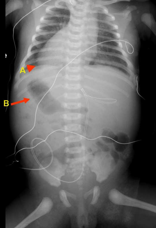 Imagen de rayos X que muestra dextrocardia (desplazamiento del corazón hacia la derecha). y estómago en el cuadrante abdominal superior derecho.