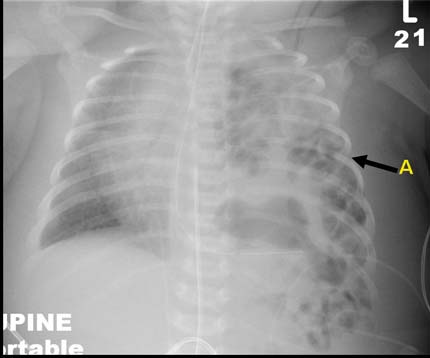 X-ray image showing a congenital diaphragmatic hernia