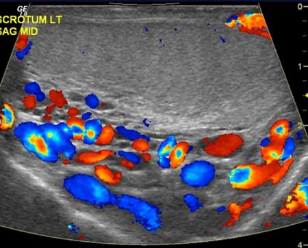 Ultrasound image with color Doppler of the left testicle