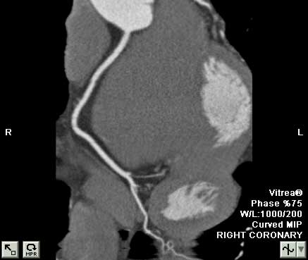  Imagen de angiografía por TC de arteria coronaria.