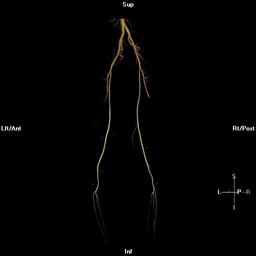 Angiograma por TAC tridimensional normal de las extremidades inferiores.