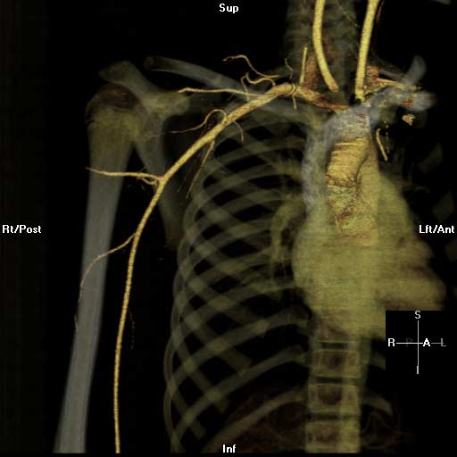 3-D CT angiogram of the right upper arm.
