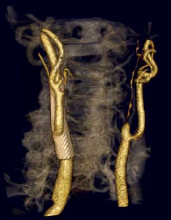 CTA image of the carotid arteries