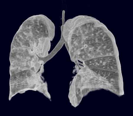 Imagen de TC del pulmón.