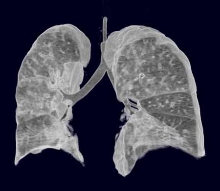 CT image of the lung