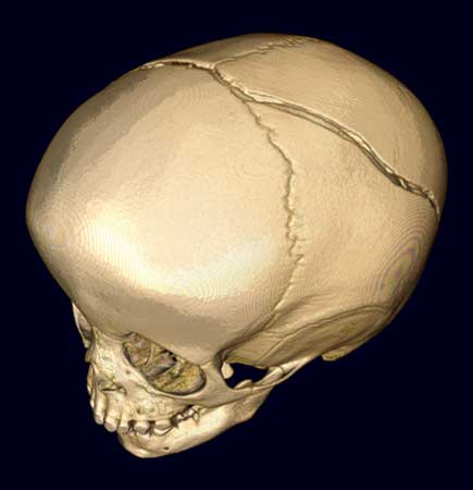 Imagen 3D que muestra una gran fractura de cráneo