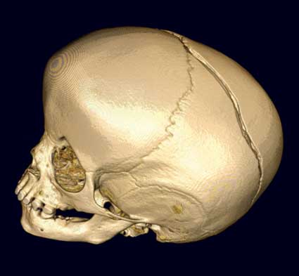 Imagen 3D que muestra una gran fractura en la parte posterior del cráneo
