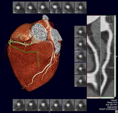 Imagen 3D CT del corazón y la arteria coronaria.