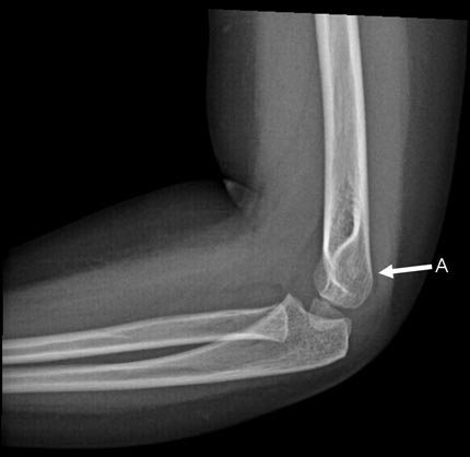 x-ray image: elbow joint effusion