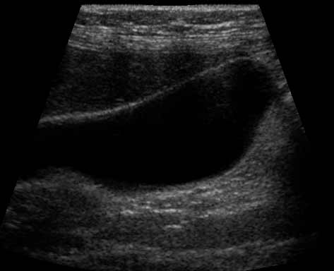 Ultrasound of the gallbladder