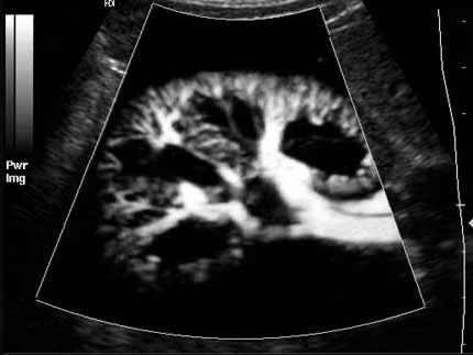 Power Doppler ultrasound of the kidney