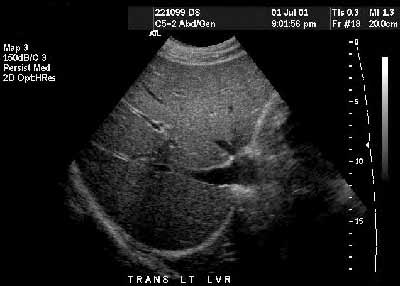 Ultrasound of the liver