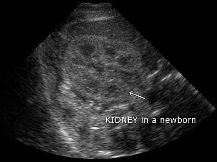 Ecografía del riñón derecho en un recién nacido