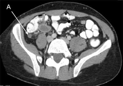 Apendicitis