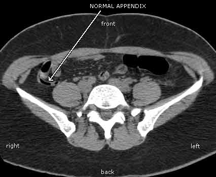 Tomografía computarizada de un apéndice normal