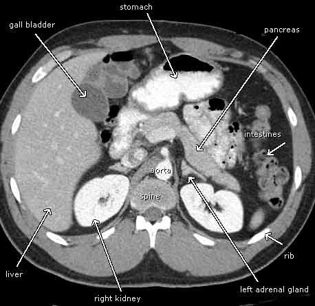 Tomografía computarizada que muestra órganos abdominales normales