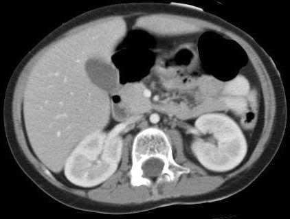 CT scan of a normal  abdomen