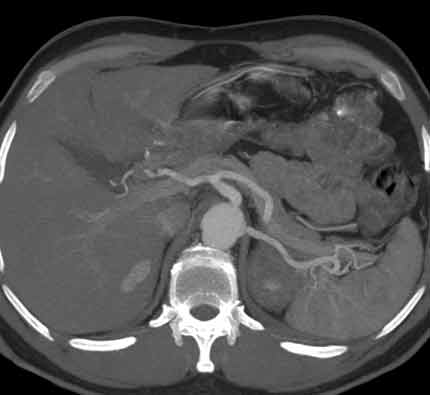 Imagen de la parte media del abdomen que muestra el hígado y los intestinos