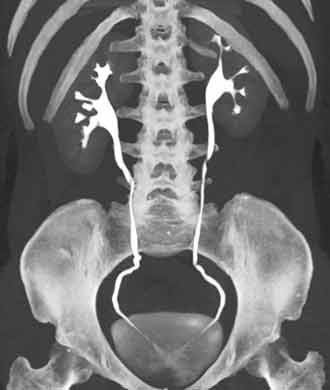  3D CT image of the kidneys and ureters