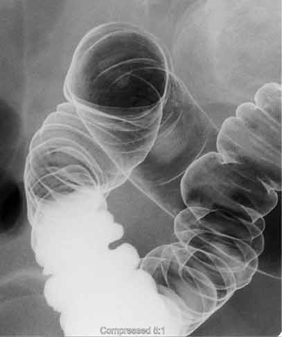 La imagen muestra el lado derecho del colon