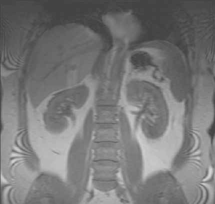 Abdominal MRI showing liver and kidneys