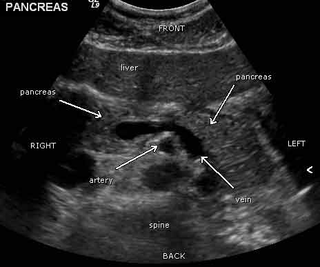A sonogram showing a normal pancreas