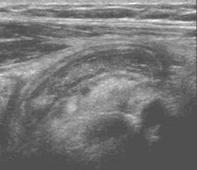 Ultrasonido de apendicitis en una niña