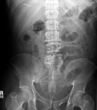 Image showing mild dilation of the small bowel gas