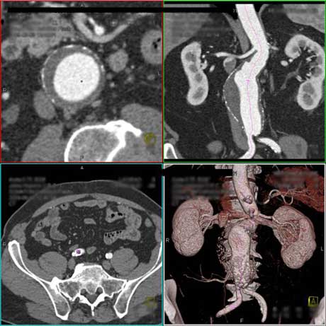 3D CT images of the abdominal aorta