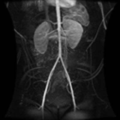 MRA of a child's abdominal and pelvic vessels