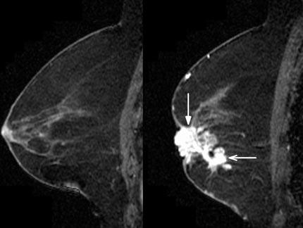 Contraste es administrado durante una RMN de seno 