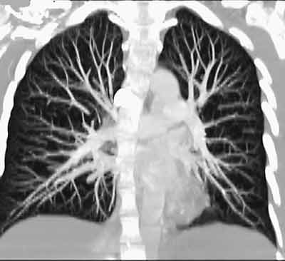 Angiografía por TC que muestra vasos pulmonares