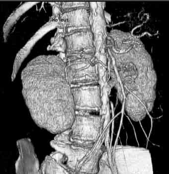 CT scan of the aorta