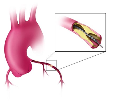 El dibujo ilustra angioplastía usada para tratar la placa.