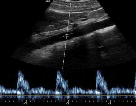 Ultrasound, abdominal aorta 