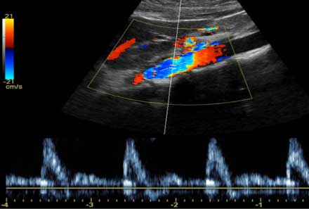 Ultrasound, abdominal aorta 