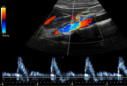  Ultrasonido, aorta abdominal