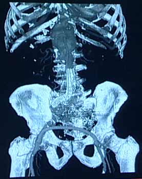  TAC que muestra un endoinjerto aórtico e injerto de derivación de la arteria femoral.